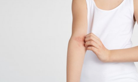 ¿Cómo cuidar tu piel atópica cuando hace mucho calor? | BIODERMA